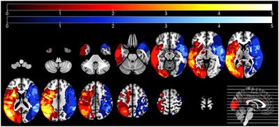 Resting state correlates of picture description informativeness in left vs. right hemisphere chronic stroke